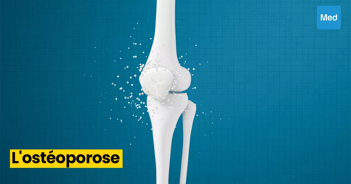 Comprendre et Prévenir l'Ostéoporose : Des Os Solides pour une Vie Saine